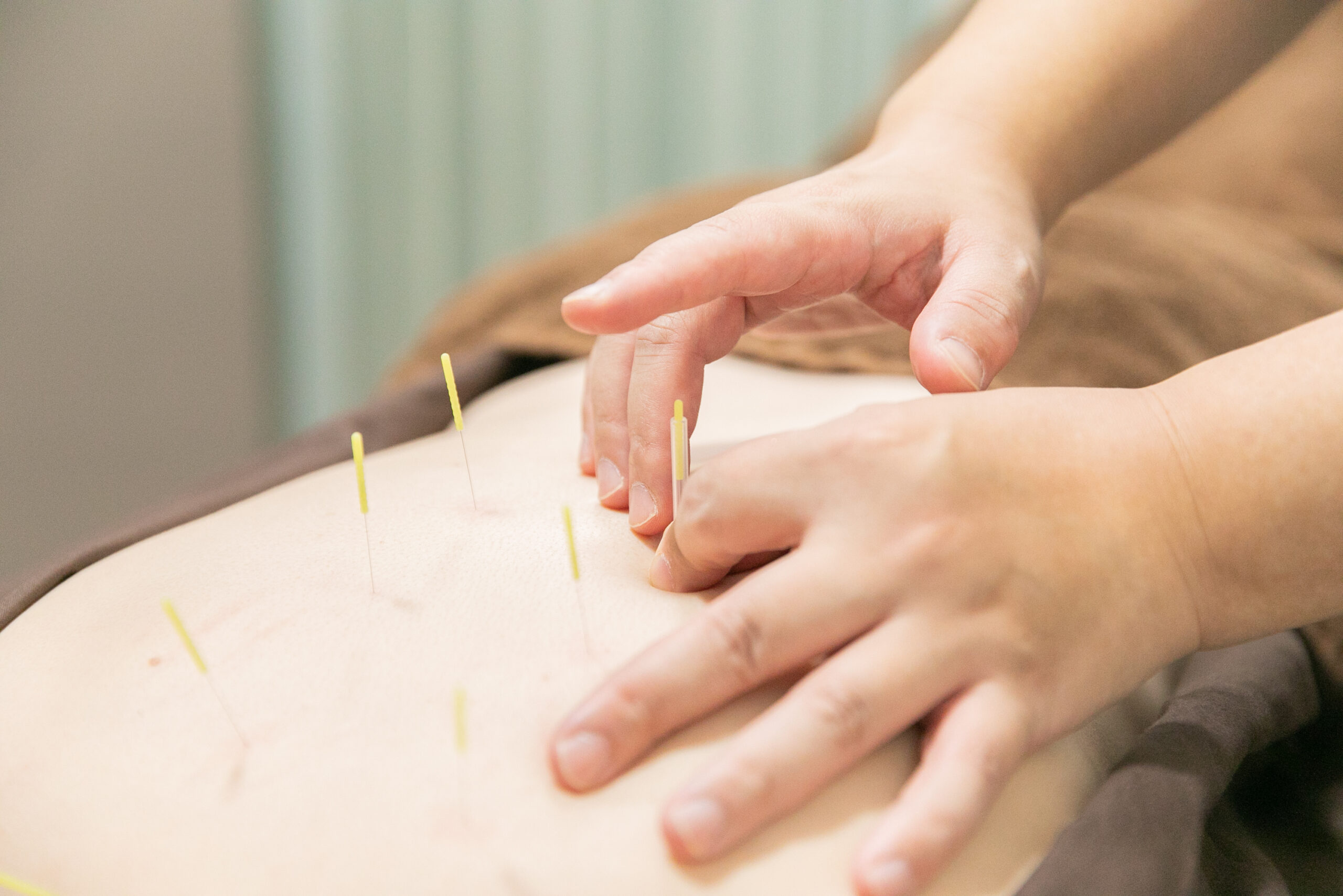代官山 中目黒 鍼灸 女性 美容鍼