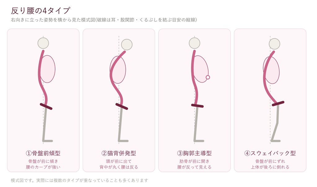 反り腰の4タイプ 分類